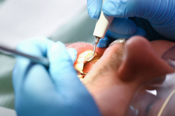 Best Emergency Root Canal Treatment in Ravenswood, WV